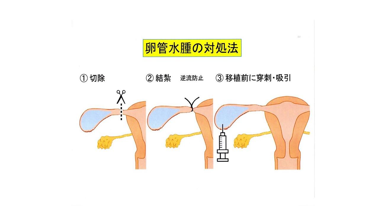 卵 管 水腫 妊娠 でき た