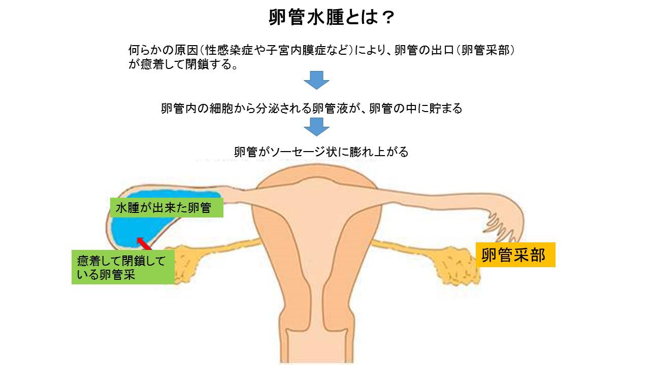 卵 管 水腫 妊娠 でき た