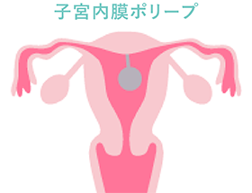 子宮内膜ポリープ
