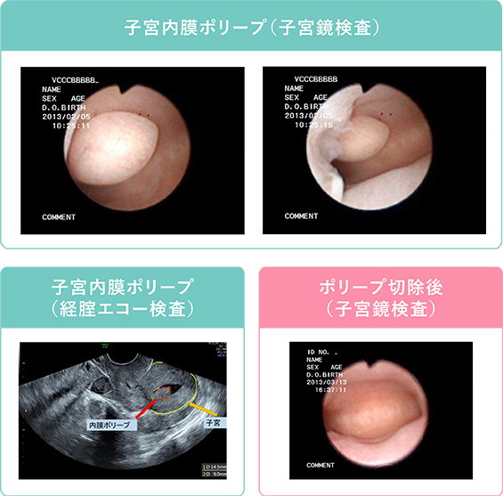 子宮 頚 管 ポリープ おり もの