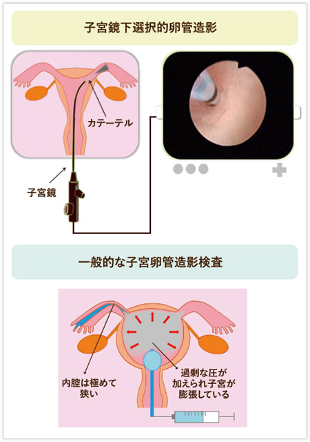 子宮鏡下選択的卵管造影