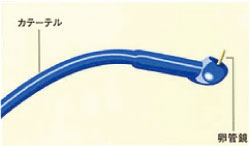 細い内視鏡（卵管鏡）を内蔵した細い管（カテーテル）を用意します。
