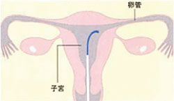 カテーテルを膣から 子宮へと挿入し卵管に近づけます。