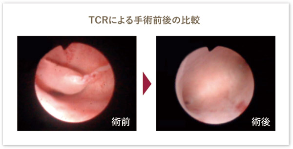TRCによる手術前後の比較