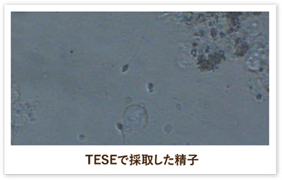 精巣内精子採取術（TESE）